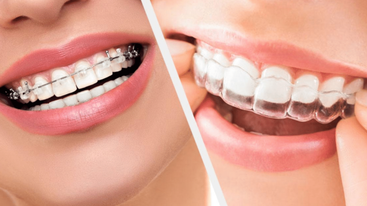 Bagues linguales ou outlet invisalign