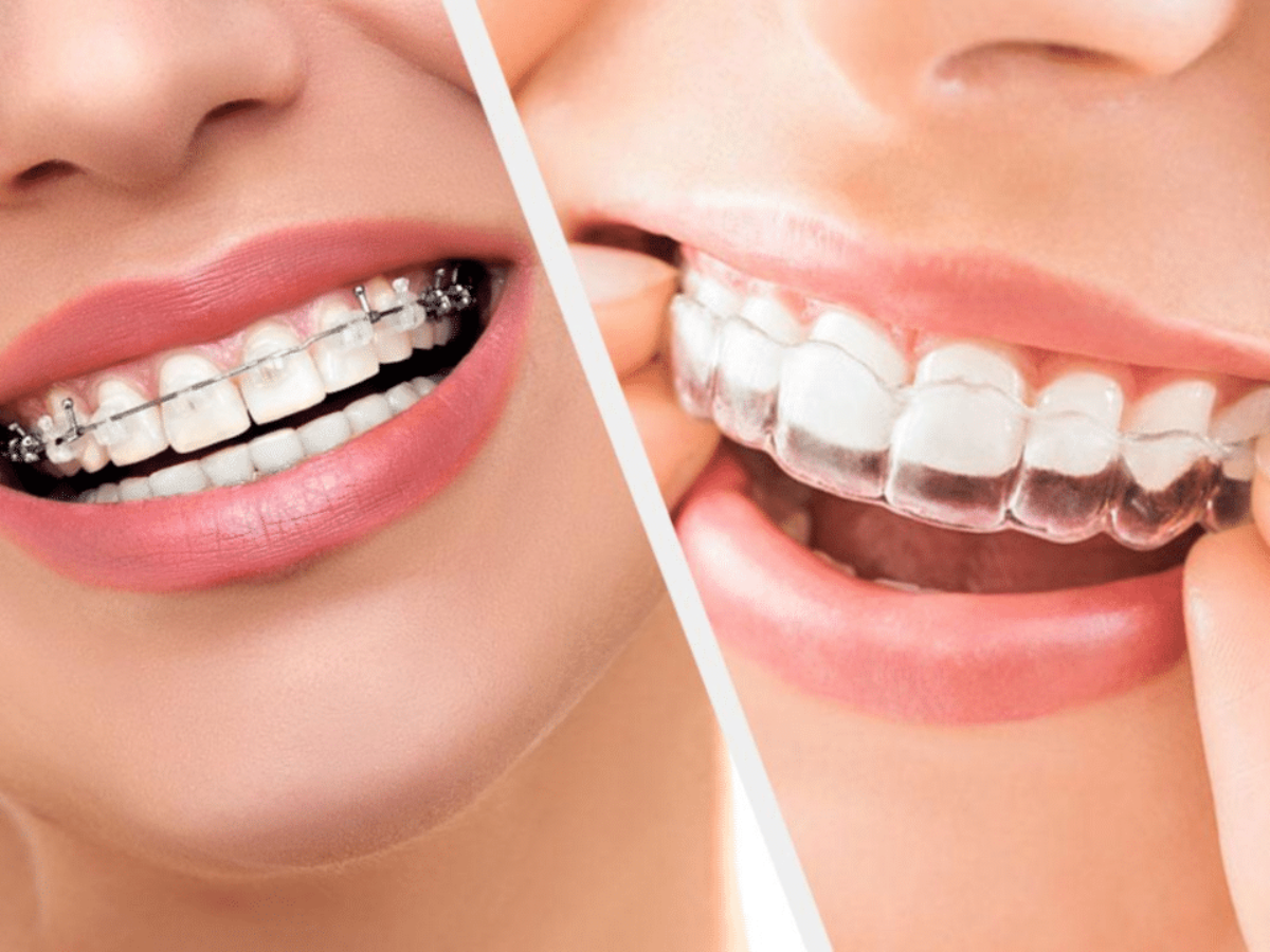 Guide sur les differents appareils en orthodontie chez l adulte