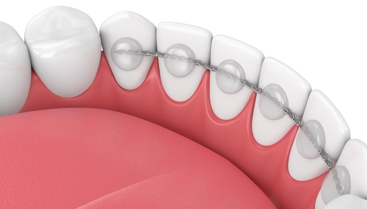 Dispositif bucco-dentaire première dentition (2 à 6 dents