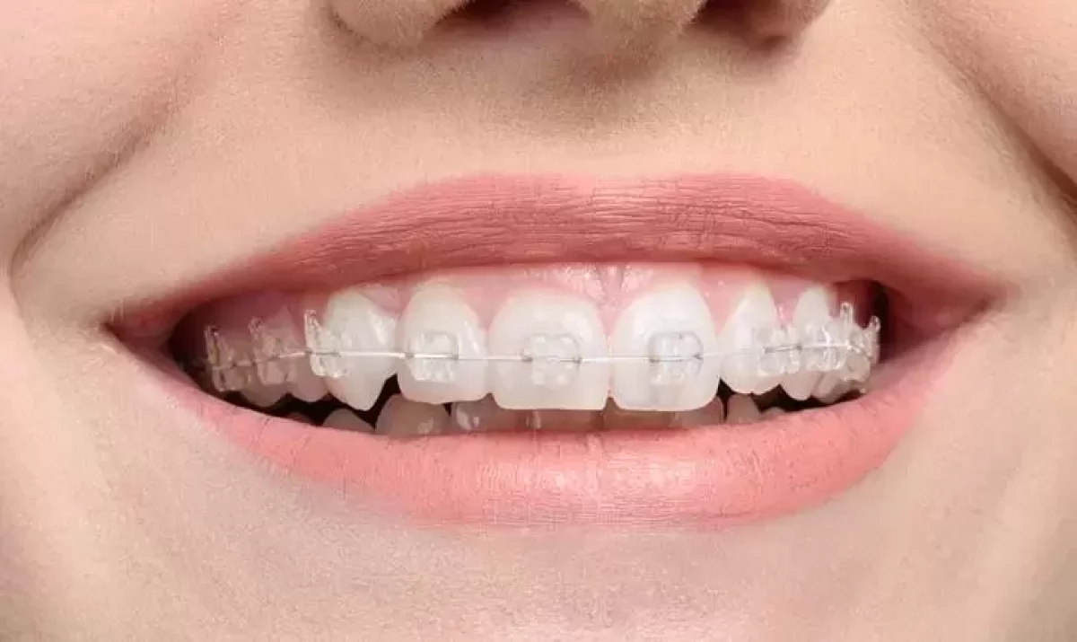 Bagues et orthodontie le guide sur les diff rentes techniques