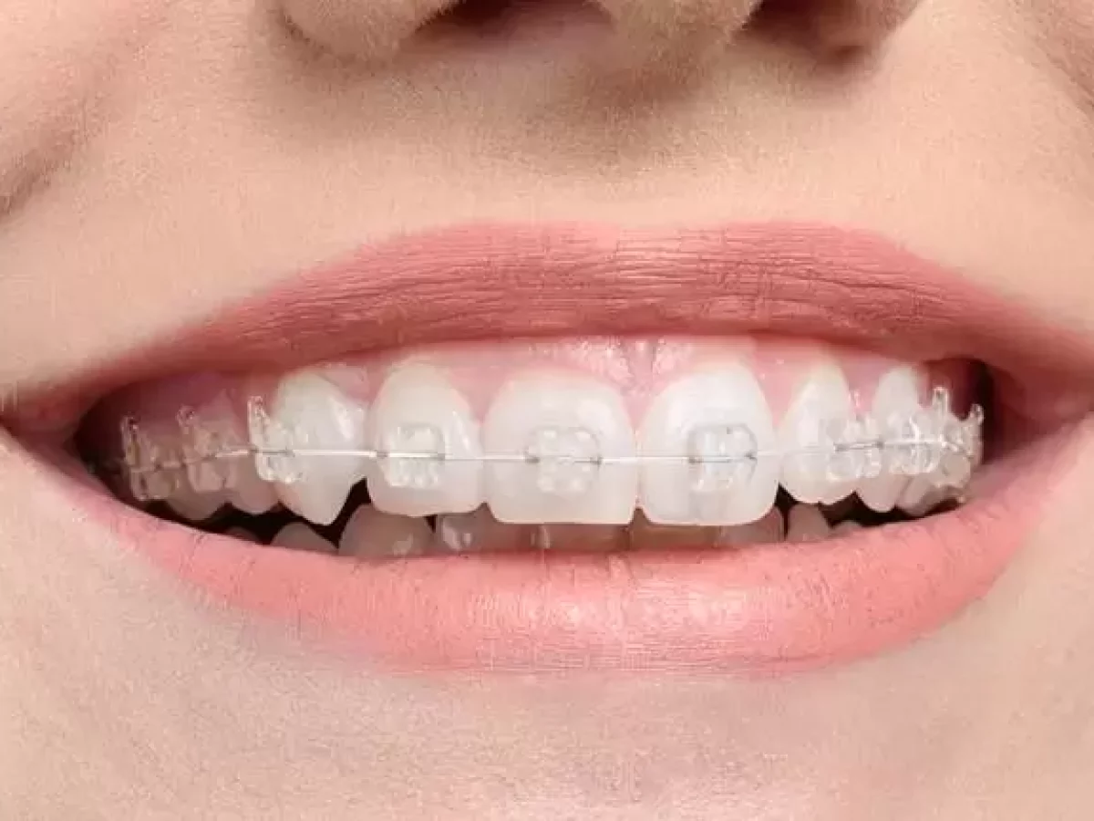 Bagues et orthodontie le guide sur les diff rentes techniques